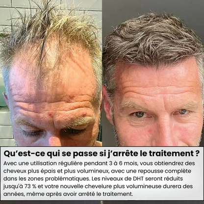 Leralia™ Système de Repousse Capillaire