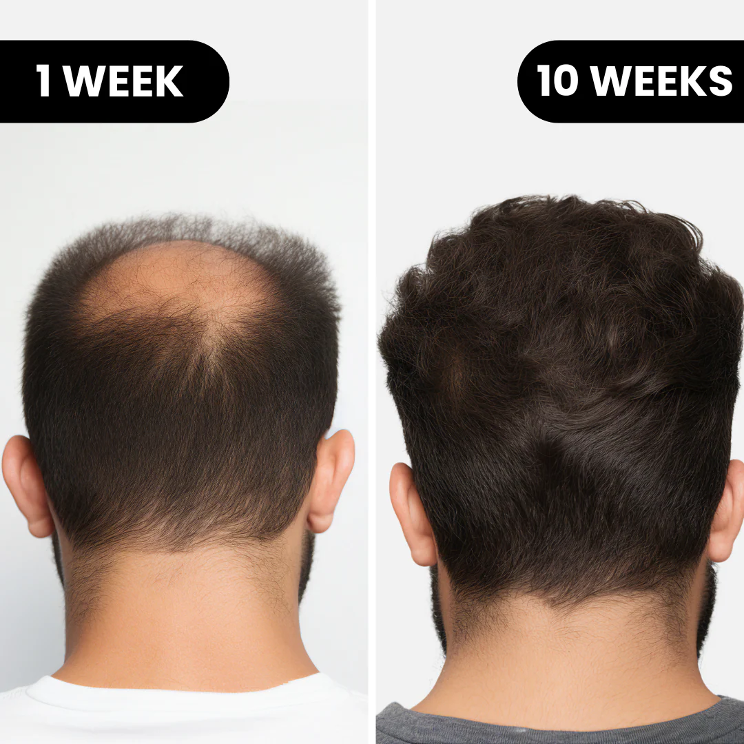 Leralia™ Système de Repousse Capillaire